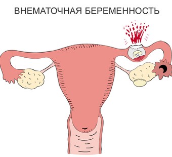 Фото: причины внематочной беременности, признаки внематочной беременности, диагностика внематочной беременности, внематочная беременность на тесте, лечение внематочной беременности, повторная внематочная беременность